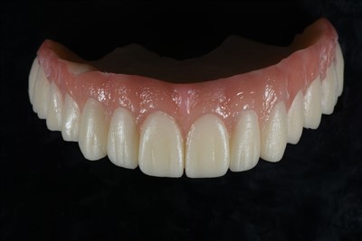 تاج مؤقت راتنج أكريليك